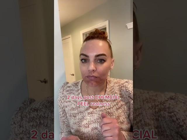 Real talk - chemical peels can mean downtime! #chemcialpeel #peels
