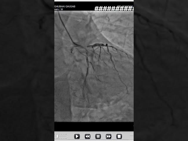 Pre LCX 99% strnosis RCA 100% occlusion #trending #shorts #art #viral