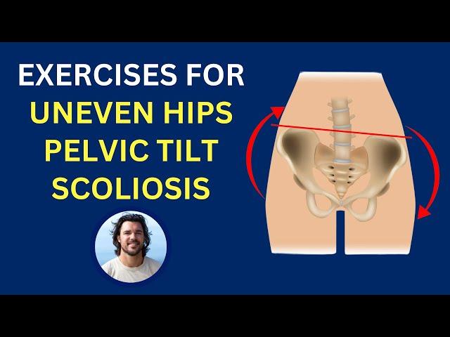 BEST Exercises for Uneven Hips, Scoliosis, Pelvic Imbalance