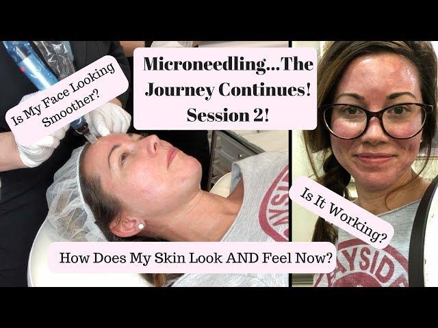 Microneedling Procedure for Acne Scars & Textured Skin: Part Two