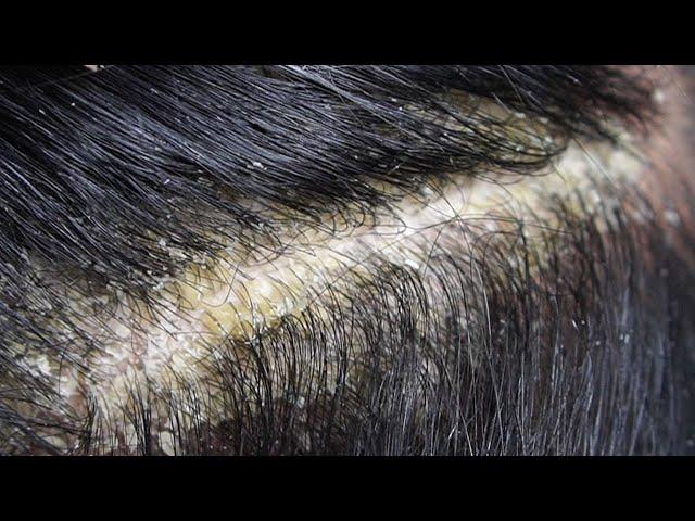 Dandruff scratching removal on head using black combing#54