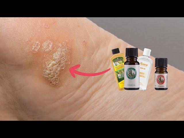 Combatting Warts with Melaleuca Products