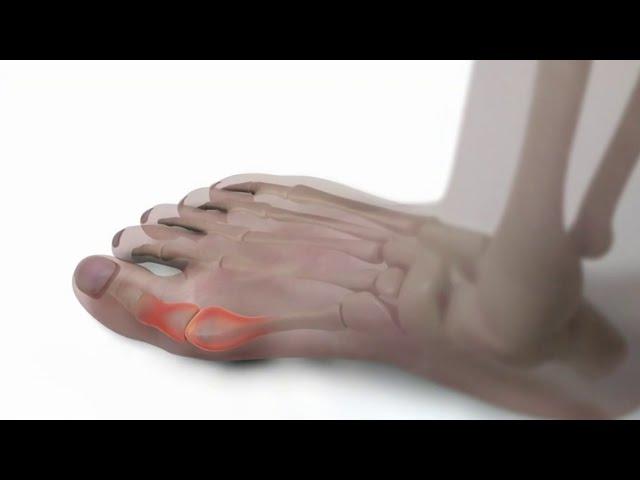 Battling bunions: What causes them, how they can be managed