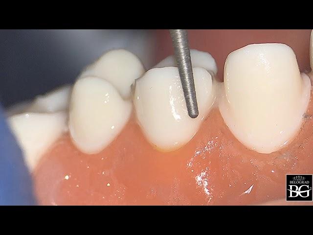 Step-by-step crown preparation for upper premolar. Препарирование под коронку верхнего премоляра.