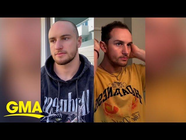 TikTok influencer who started losing hair at 19 breaks stigma around male hair loss l GMA