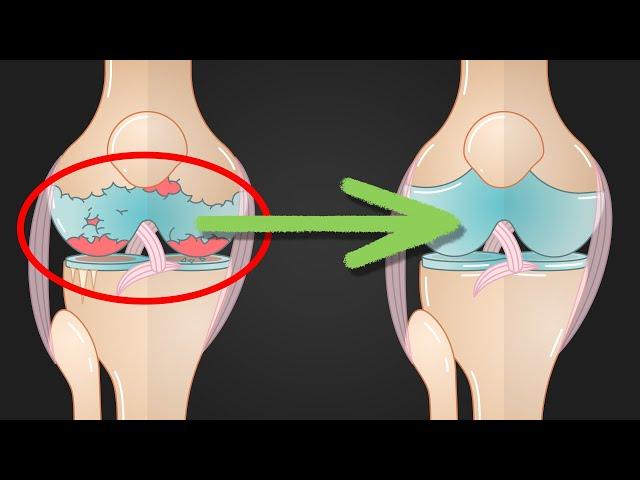 Deine Gelenke – DAS solltest du wissen! (Arthrose, Knorpel)