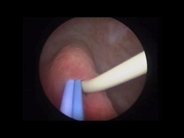 Accordion URS for Migrated Stents