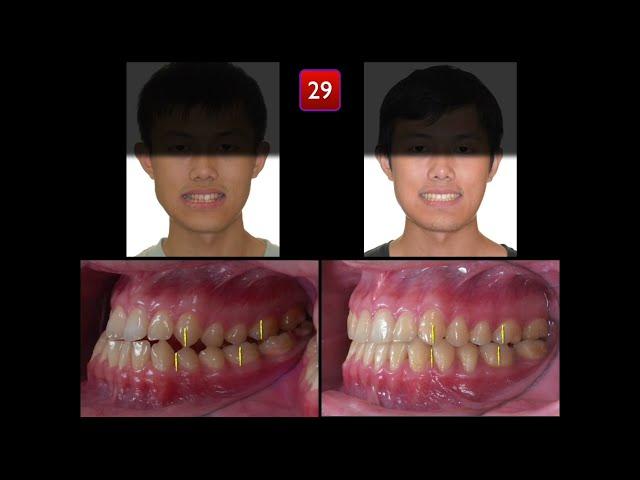 Skeletal Class III with functional shift | 【Chris Chang Ortho】CC822