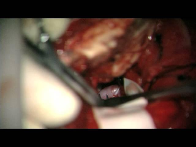 Clip reconstruction of giant vertebral artery aneurysm after failed flow reduction therapy
