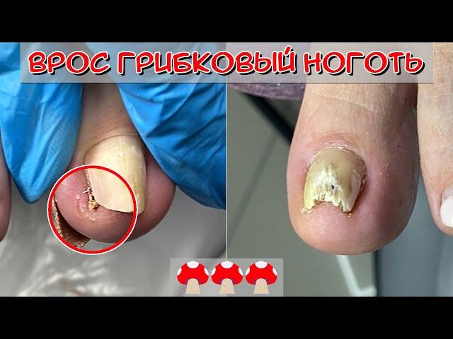 Ingrown Toenail / Toenail Fungus