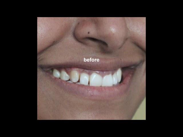 Overlapping teeth ?  Smile Makeover  Watch now !