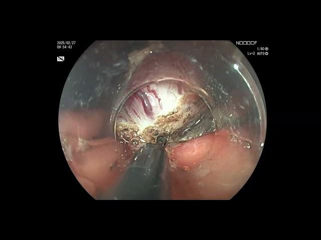Gastric EFTR (endoscopic full-thickness resection)