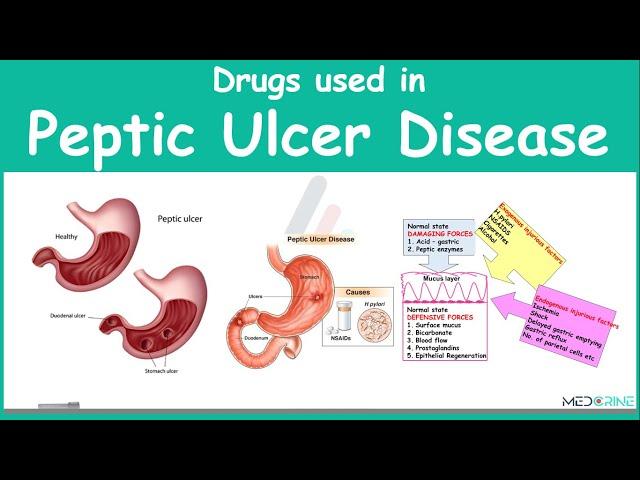 Drugs Used in Treament of Peptic Ulcer Diseae Pharmacology