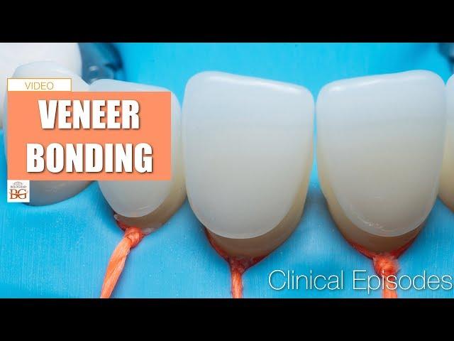 veneer bonding