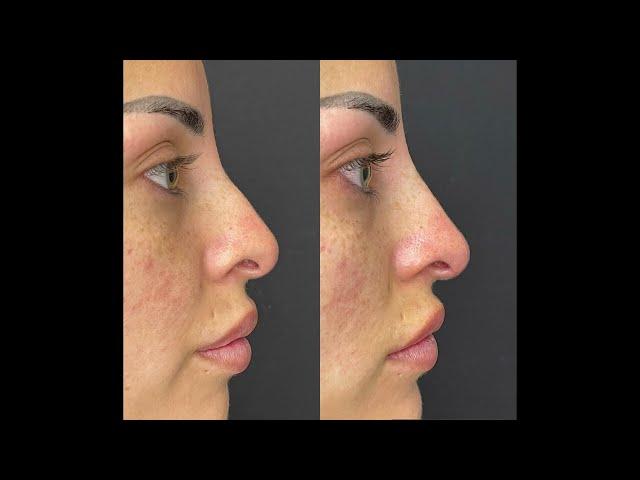 Non-Surgical Nose Job by dermal filler - Ageless MD of Dr. Tsay