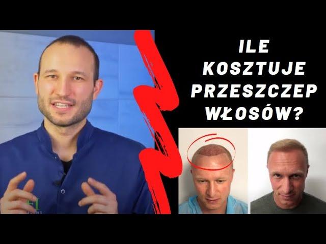 Ile kosztuje przeszczep włosów? [Dlaczego skąpy dwa razy traci] Cena przeszczepu włosów