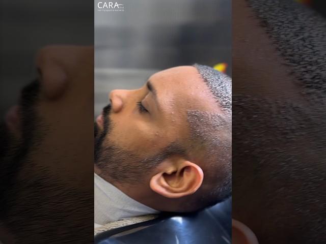 Head Wash After Hair Transplant | Scabs Removal Hair wash