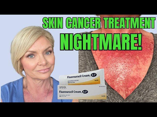 THE UGLY TRUTH ABOUT SKIN CANCER: My Fluorouracil Treatment Journey