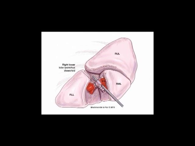 STS University 2018 - Course 6: VATS Lobectomy