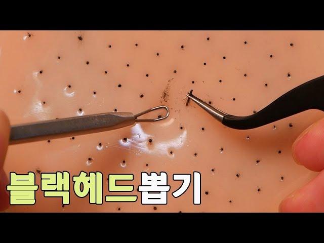 【 SUB】 Handmade black_head removal toy