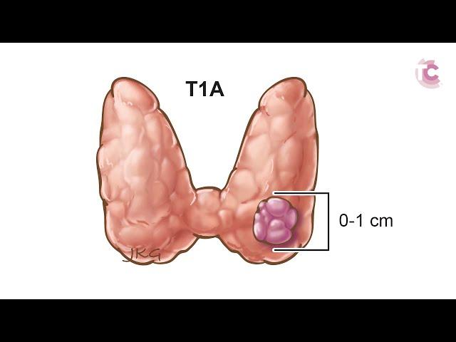 Thyroid Cancer: what is my prognosis?