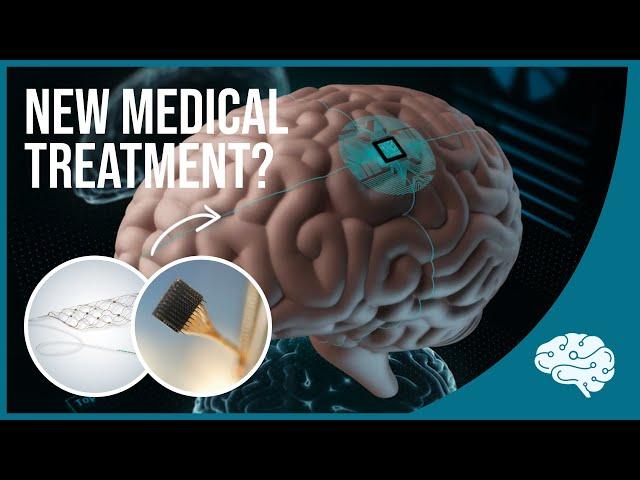 Brain Implants are Here: Blackrock's Neuroport & Synchron's Stentrode