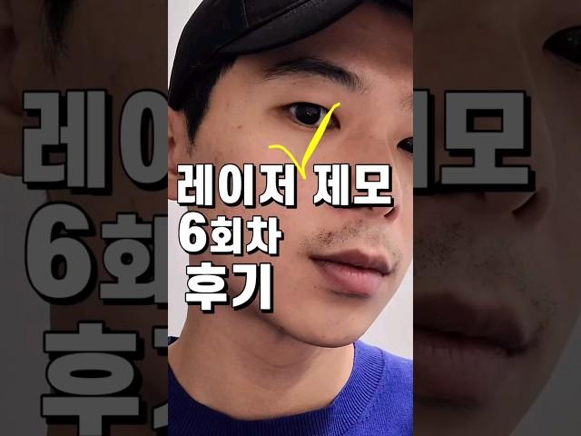 수염제모 레이저 후기_수염제모전후비교_30대남자 자기관리