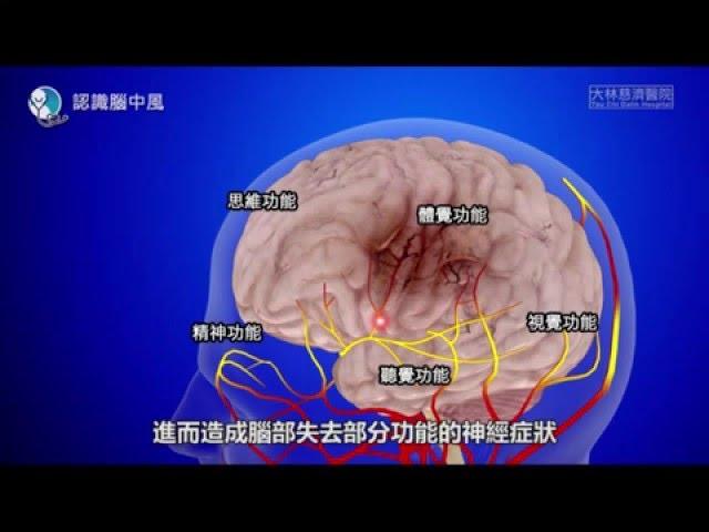 【科普教育】認識腦中風