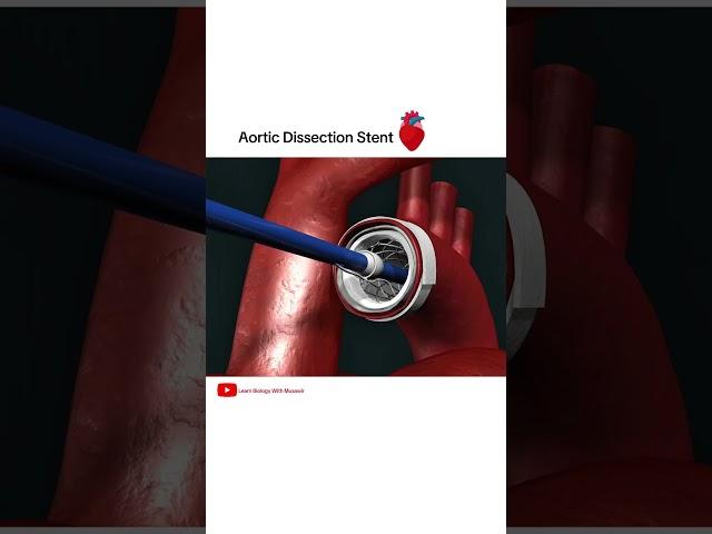 Aortic dissection Stent grafting #cardiology #shorts