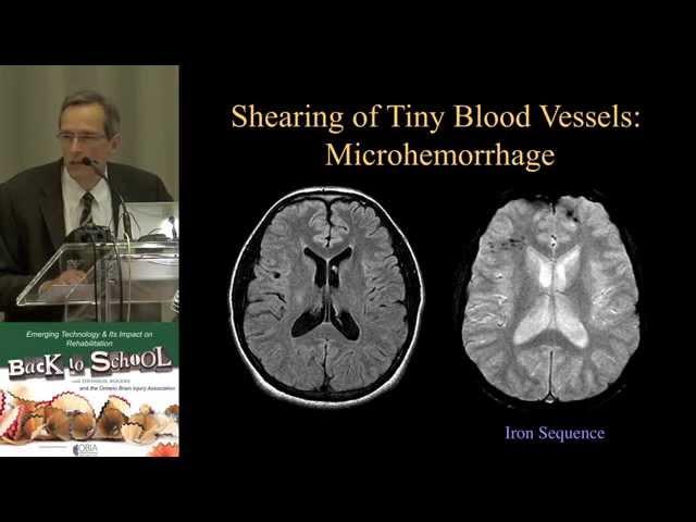 MRI of Truamatic Brain Injury by Dr.  David J  Mikulis