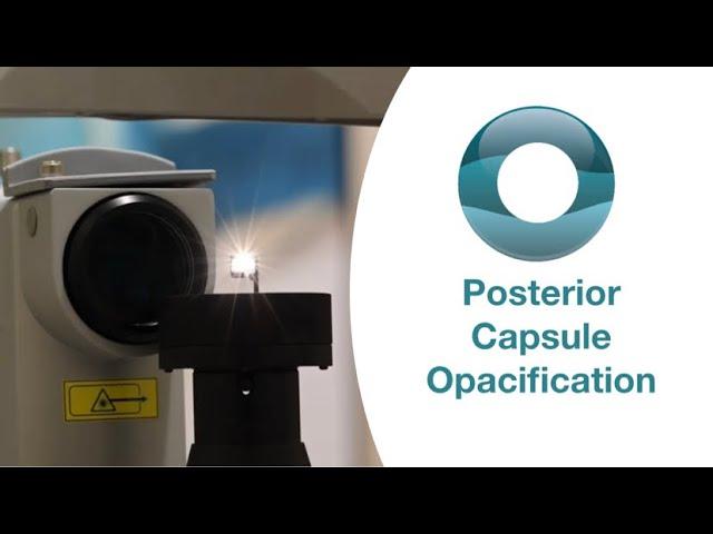 Yag Laser Capsulotomy for Posterior Capsule Opacification