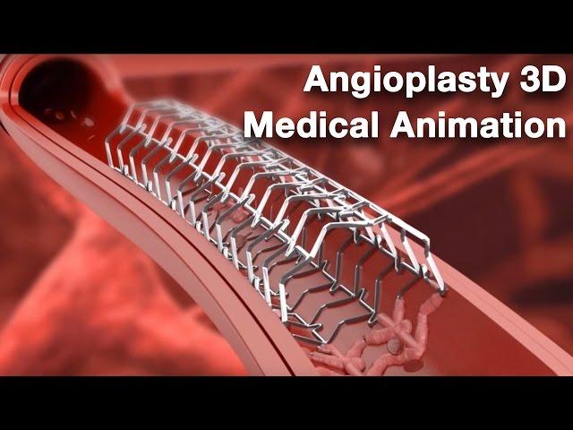 Angioplasty - Medical animation