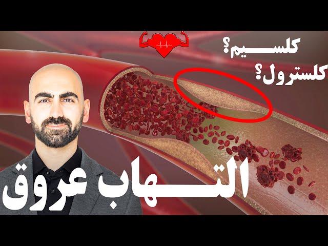 #17 - التهاب عروق | گرفتگی عروق، بیماری های قلبی و نقش کلسیم