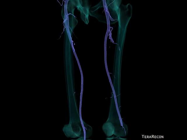 acute thromboemboli to left lower extremity