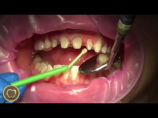 Zirkonyum Diş - Zirkonyum Kaplama- (Zirconium Crowns in Turkey)@GoldenSmileDent