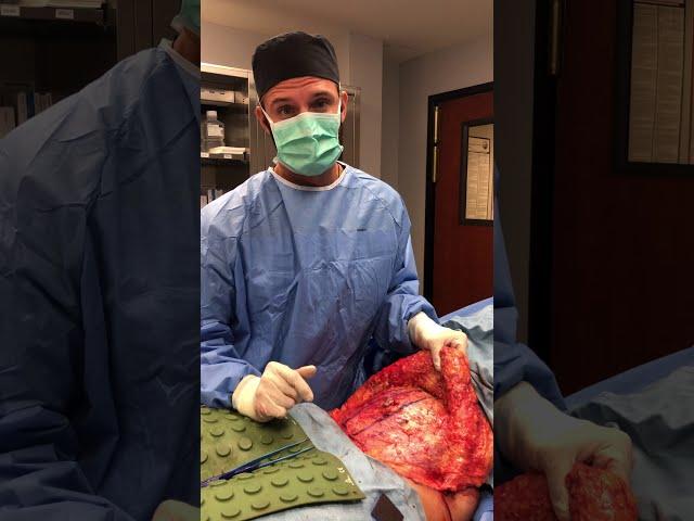 Rectus Diastasis Repair During Tummy Tuck