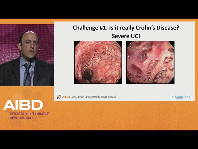 Challenges in the treatment of severe Crohn's disease