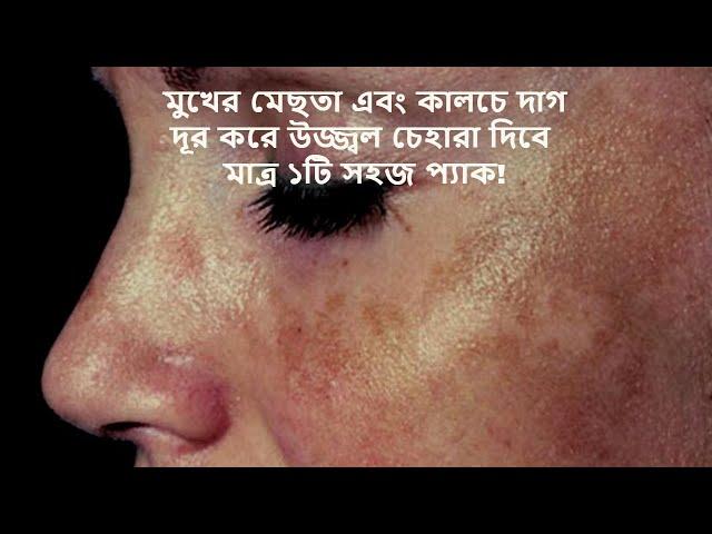 মুখের মেছতা দূর করার উপায় কি?