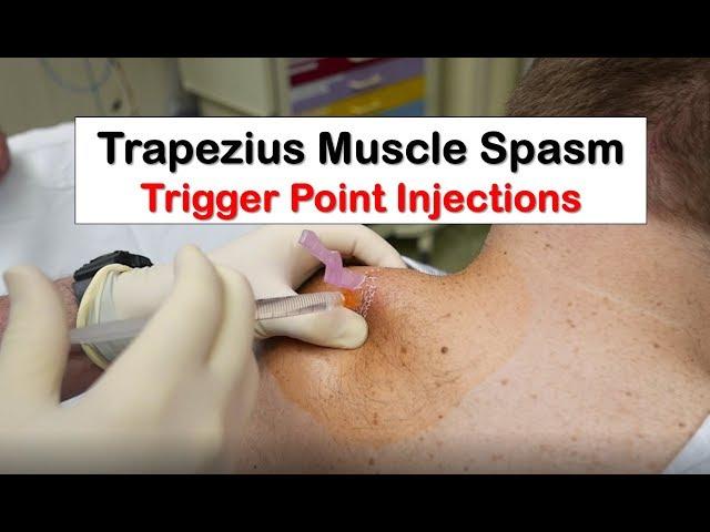 Trapezius Muscle Spasm Trigger Point Injection