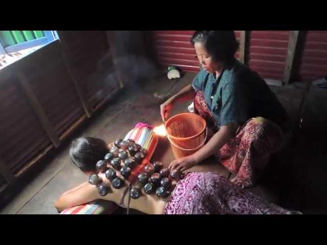 Cupping--Cambodian-style!