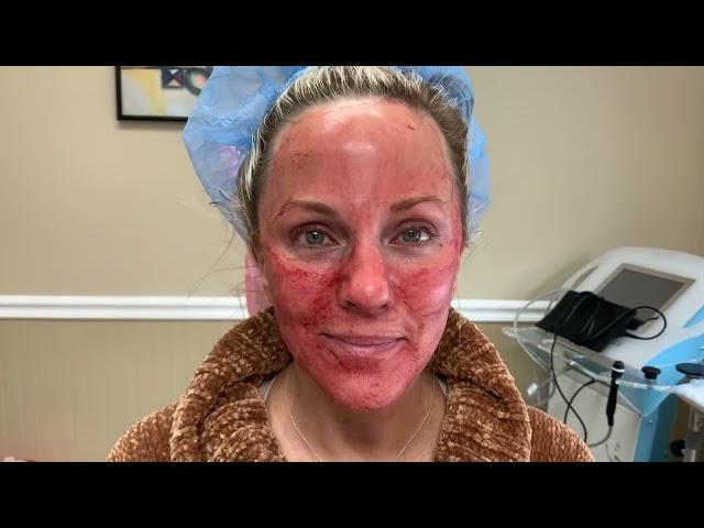 WHAT IS PRP? - PRP FACELIFT - MICRONEEDLING - DR. TANVEER JANJUA - NEW JERSEY