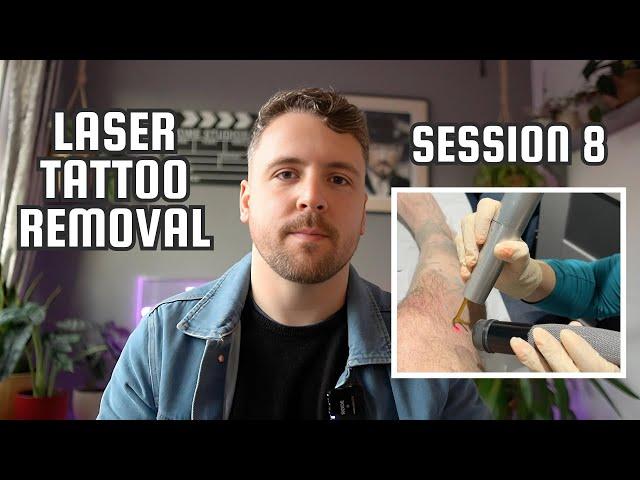 Laser Tattoo Removal | Session 8 | Before & After