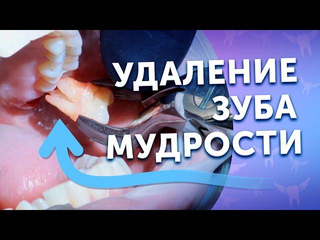 Процесс удаления зуба мудрости