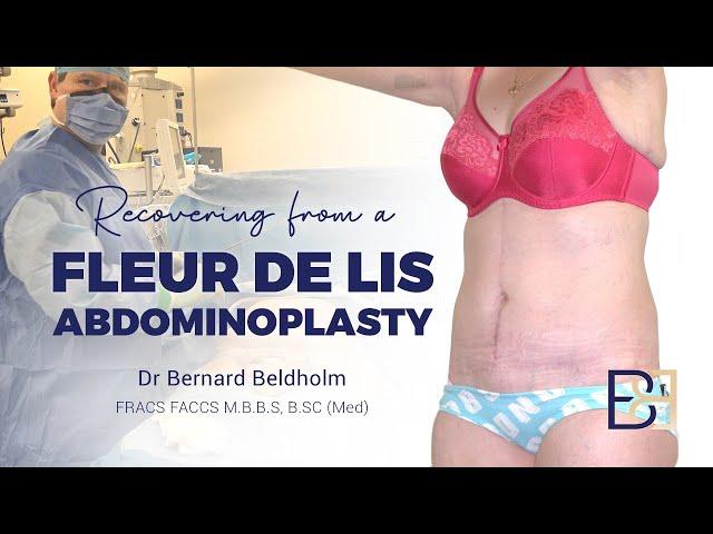 Recovering from a Fleur de lis abdominoplasty