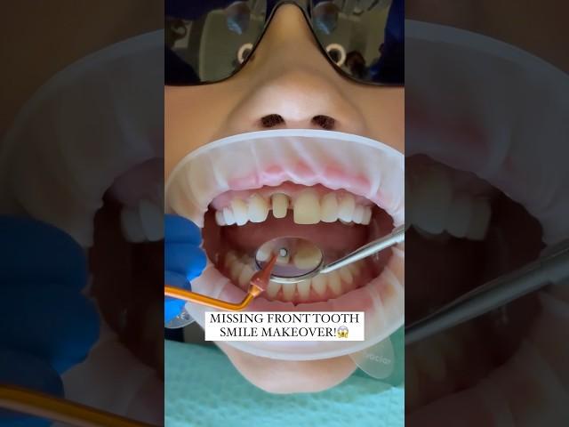 Missing Front Tooth Smile Makeover #veneers #cosmeticdentistry #smilemakeover