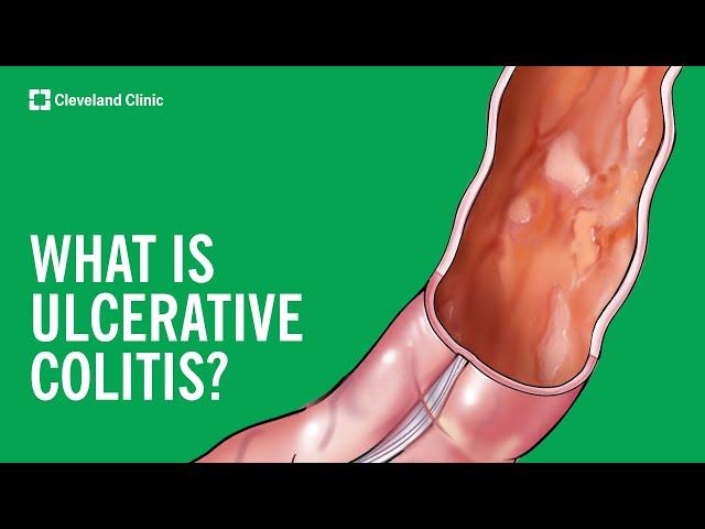 What Is Ulcerative Colitis?