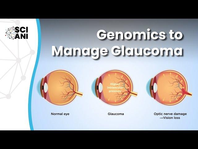 Could our genes hold the key to improved understanding and management of glaucoma?