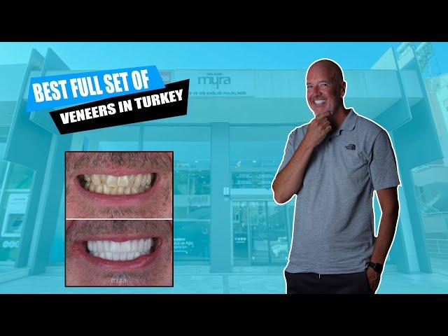 Get Zirconium Crowns / Full Veneers in Turkey | Interview with Paul | New Teeth and Smile