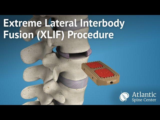 Extreme Lateral Interbody Fusion (XLIF) Procedure