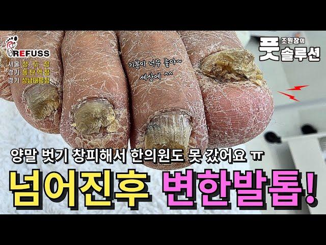 넘어진후 허리통증에 발관리 어려움! 문제성발 때문에 한의원도 못가셨다는 어머님 관리해드렸어요 #조원장의풋솔루션 #레푸스상도점 #레푸스동탄역점 #레푸스성남태평점 #레푸스 #문제성발톱